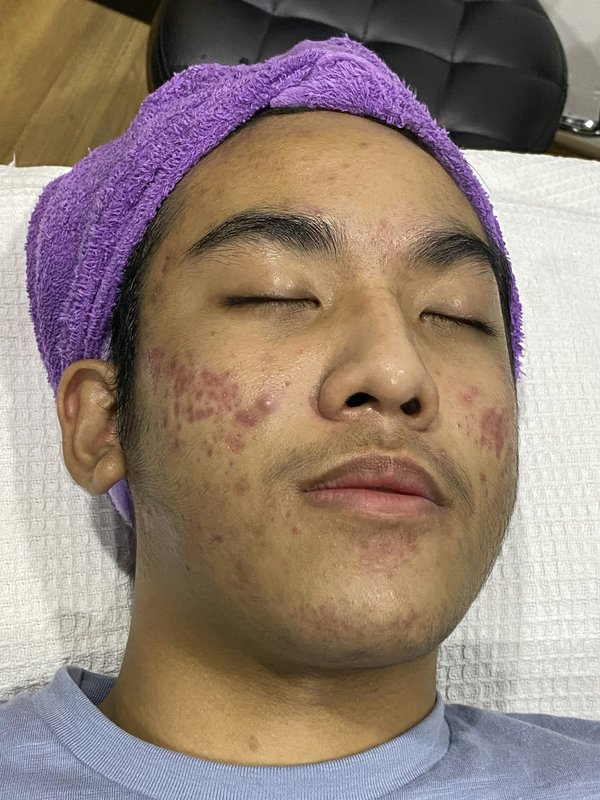 Comment se débarrasser des boutons d'acné rapidement ?